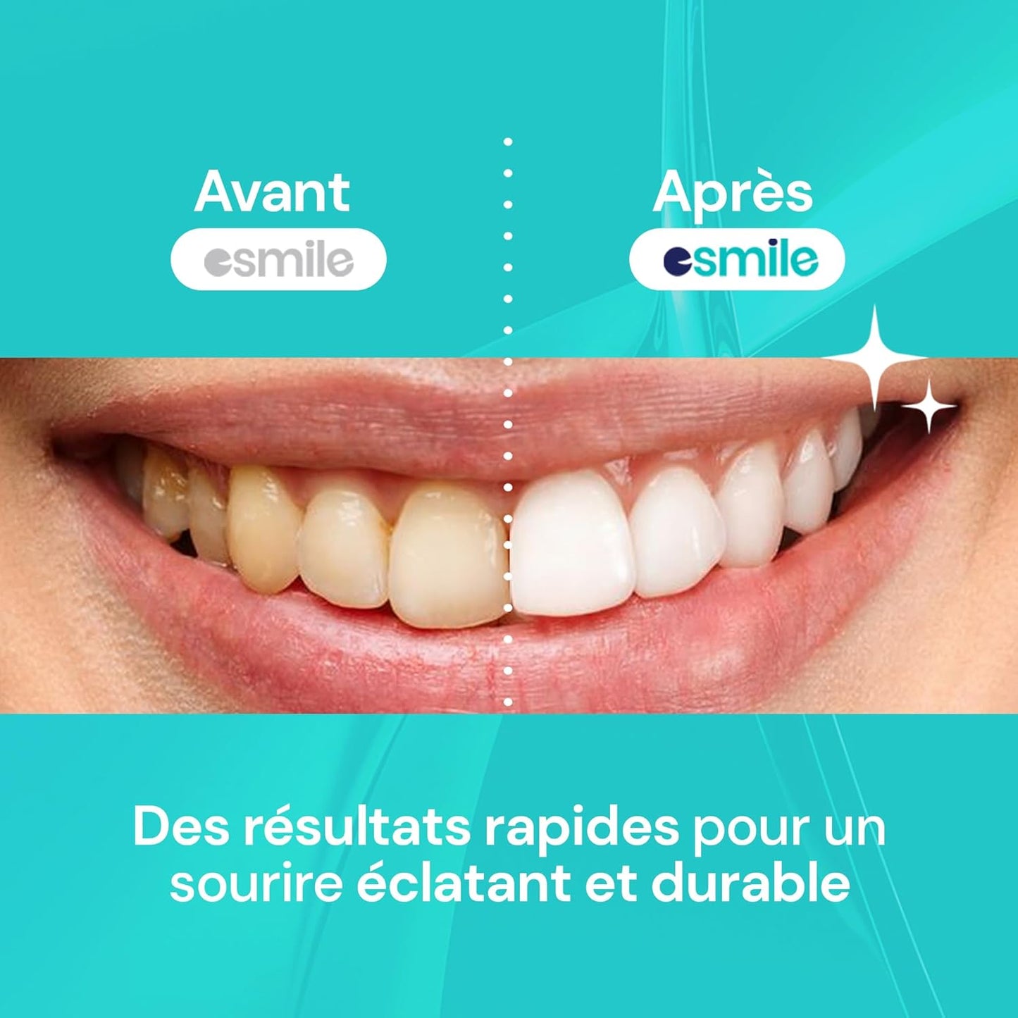 UPSHELL Easy Smile Professional Dental Whitening Kit | Device with LED Lamp 32x + 3 Whitening Gels | Removes Deep Spots | Safe and Painless Treatment at Home